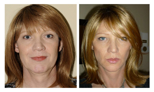 Facial Exercises Before And After 23